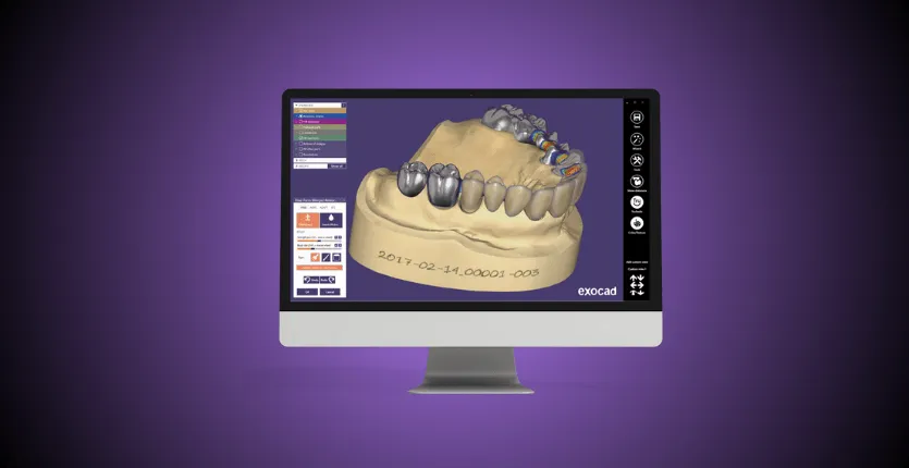 Interface du logiciel Exocad DentalCAD de conception dentaire