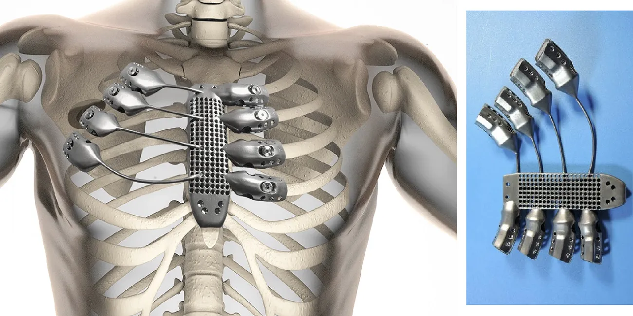 Rib implant 3d printed